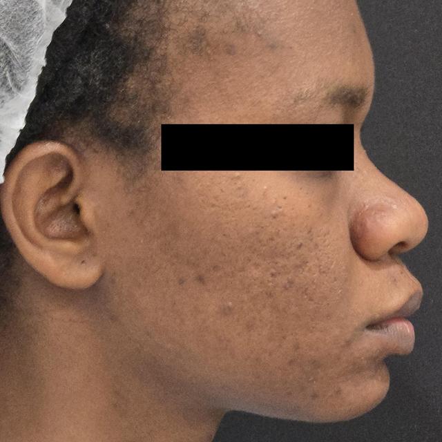 Rhinoplasty before at Dr. David Gerth Plastic Surgery in Coral Gables, FL