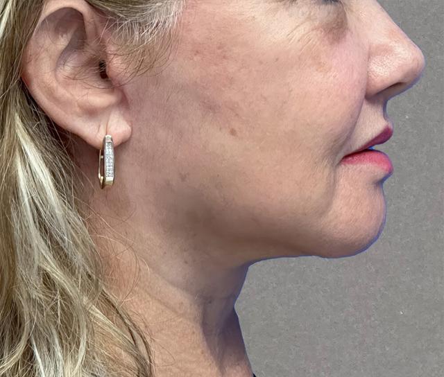 Facelift after at Dr. David Gerth Plastic Surgery in Coral Gables, FL