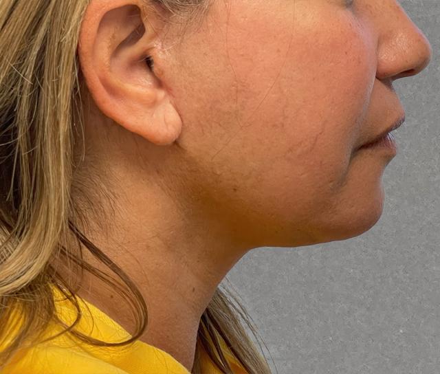 Facelift after at Dr. David Gerth Plastic Surgery in Coral Gables, FL