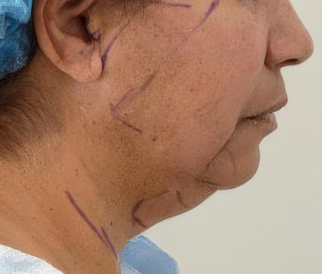 Facelift before at Dr. David Gerth Plastic Surgery in Coral Gables, FL