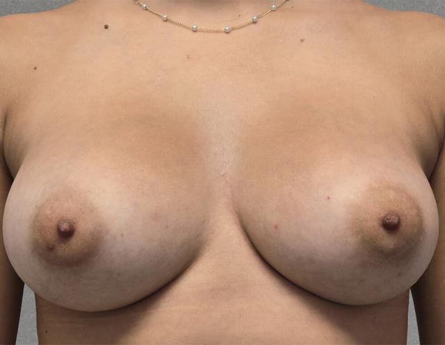 Breast Augmentation after at Dr. David Gerth Plastic Surgery in Coral Gables, FL