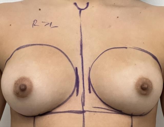 Breast Augmentation before at Dr. David Gerth Plastic Surgery in Coral Gables, FL