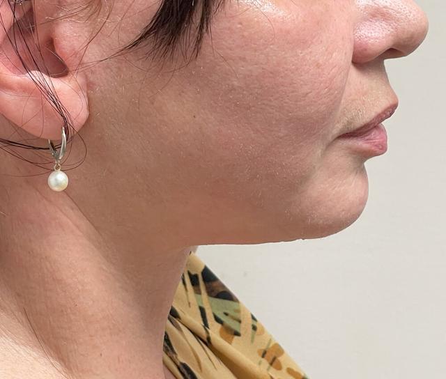 Facelift after at Dr. David Gerth Plastic Surgery in Coral Gables, FL