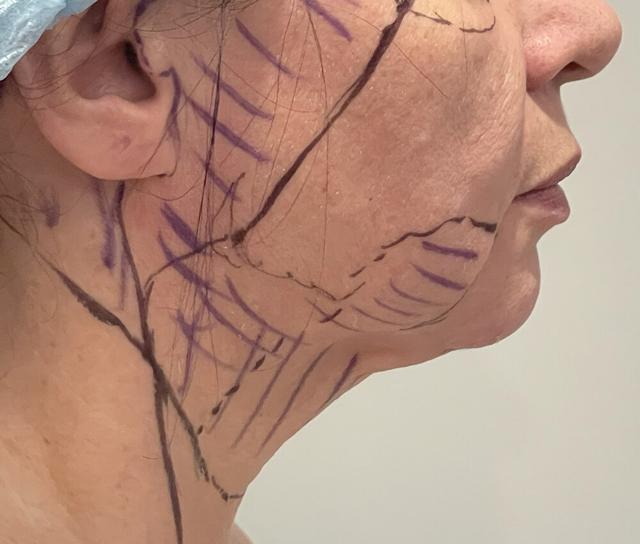 Facelift before at Dr. David Gerth Plastic Surgery in Coral Gables, FL