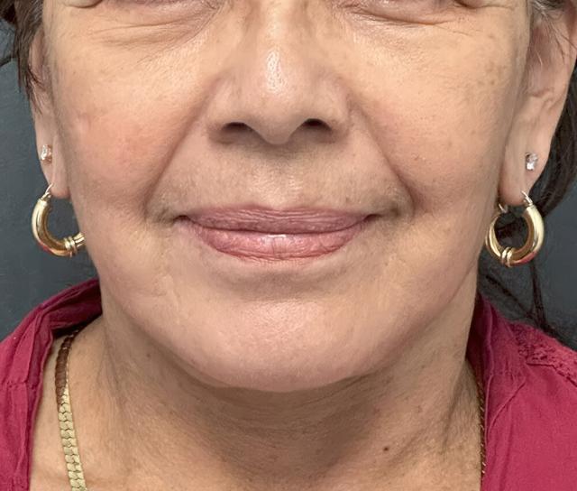 Facelift after at Dr. David Gerth Plastic Surgery in Coral Gables, FL