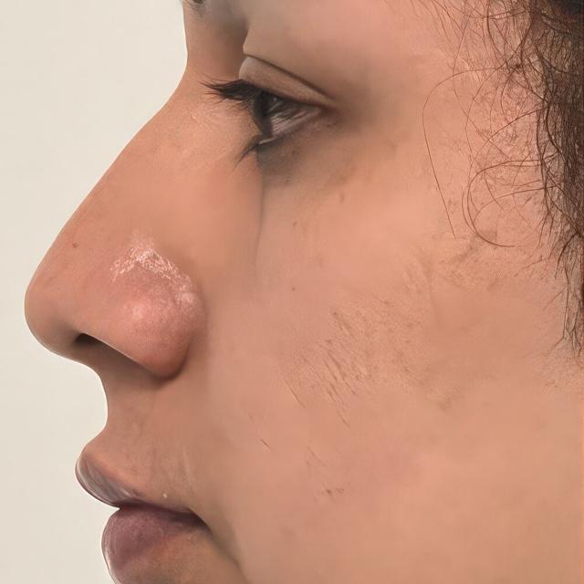Rhinoplasty before at Dr. David Gerth Plastic Surgery in Coral Gables, FL