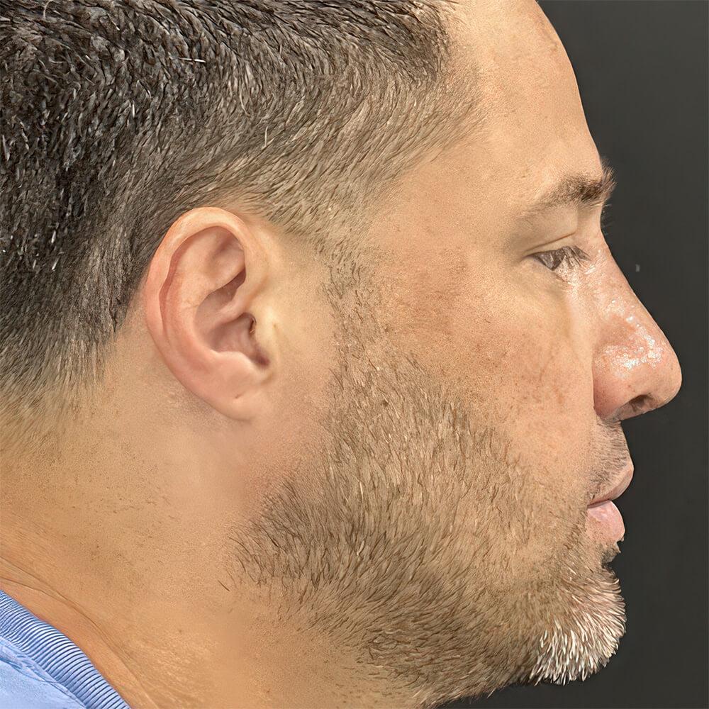 Dr. David Gerth Plastic Surgery rhinoplasty after — Coral Gables, FL