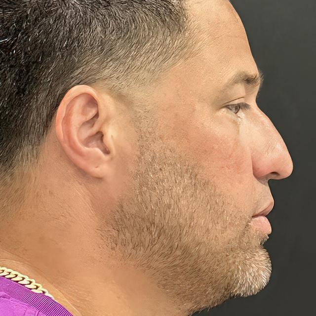 Rhinoplasty before at Dr. David Gerth Plastic Surgery in Coral Gables, FL