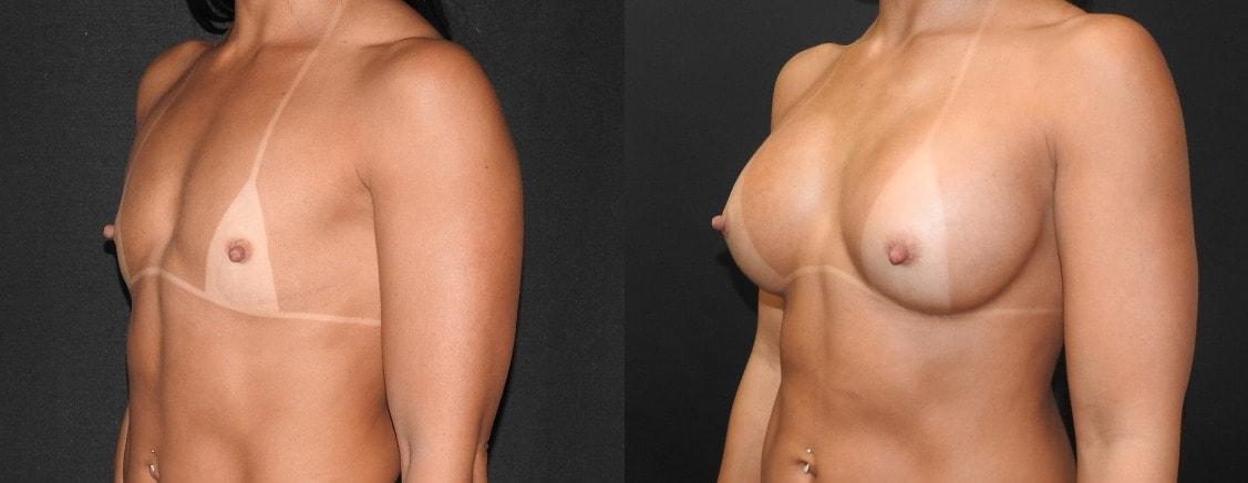 Dr. David Gerth Plastic Surgery breast augmentation result — Coral Gables, FL