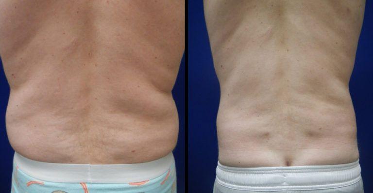 Plastic Surgery Group of Memphis liposuction result — Memphis, TN