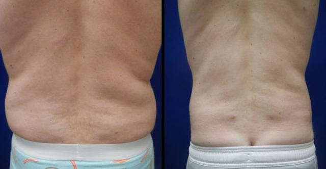 Liposuction result at Plastic Surgery Group of Memphis in Memphis, TN