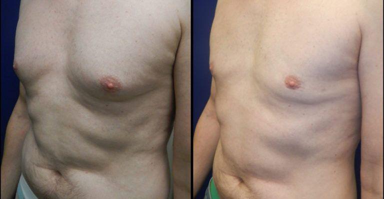 Plastic Surgery Group of Memphis gynecomastia result — Memphis, TN