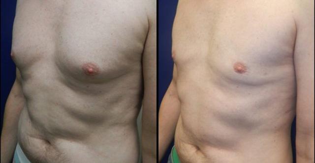 Gynecomastia Surgery result at Plastic Surgery Group of Memphis in Memphis, TN