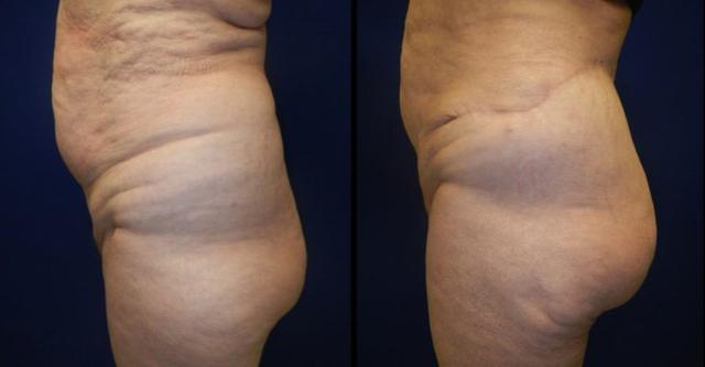 Brazilian Butt Lift result at Plastic Surgery Group of Memphis in Memphis, TN