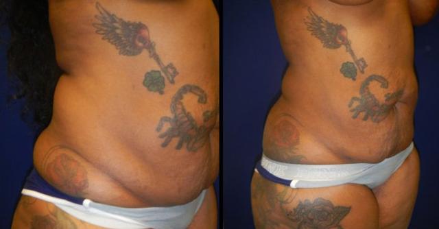 Liposuction result at Plastic Surgery Group of Memphis in Memphis, TN