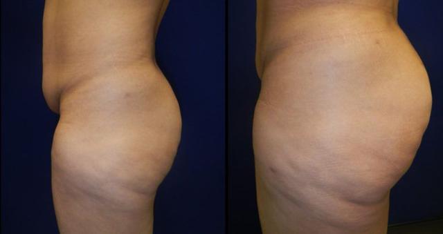 Brazilian Butt Lift result at Plastic Surgery Group of Memphis in Memphis, TN