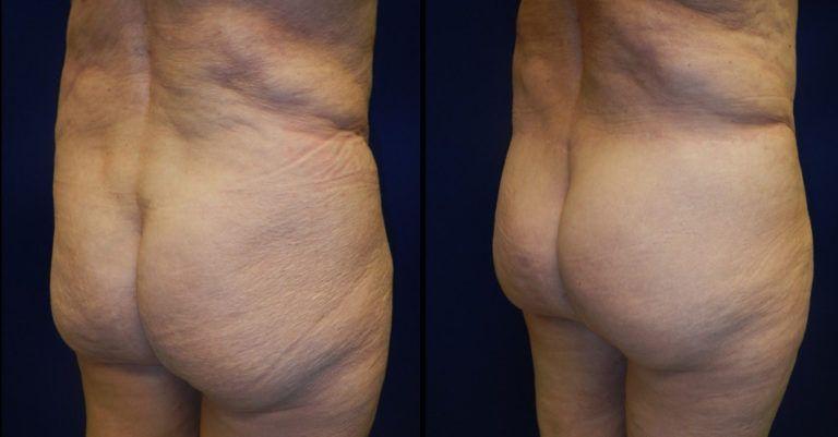 Plastic Surgery Group of Memphis bbl result — Memphis, TN