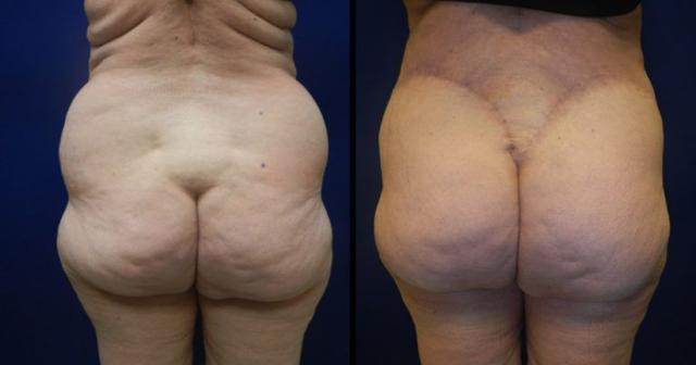 Brazilian Butt Lift result at Plastic Surgery Group of Memphis in Memphis, TN