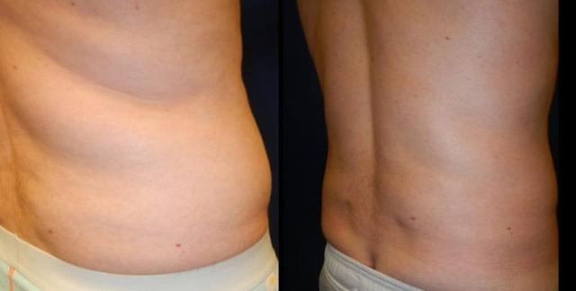 Liposuction result at Plastic Surgery Group of Memphis in Memphis, TN