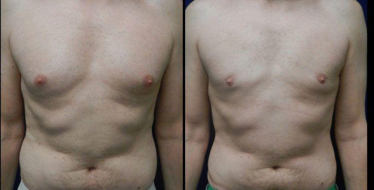 Plastic Surgery Group of Memphis gynecomastia result — Memphis, TN