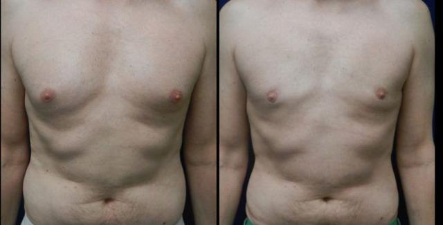 Gynecomastia Surgery result at Plastic Surgery Group of Memphis in Memphis, TN