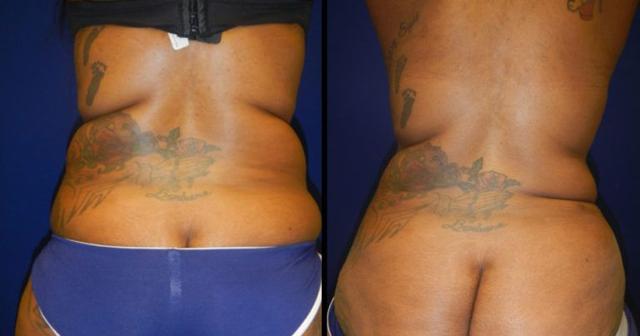 Liposuction result at Plastic Surgery Group of Memphis in Memphis, TN