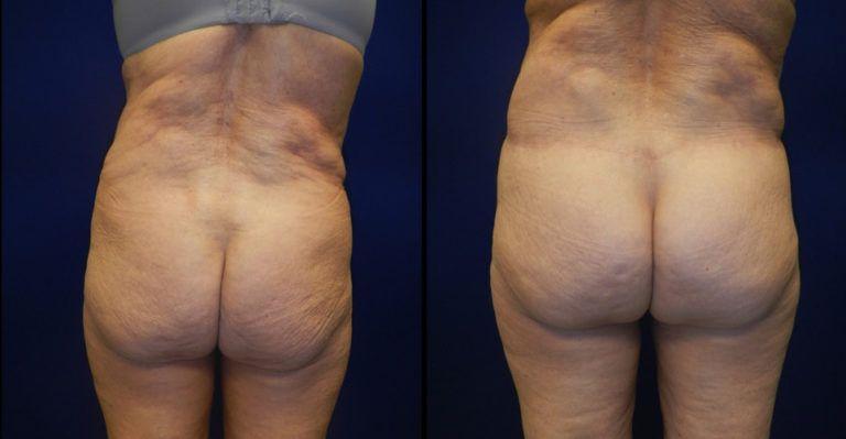 Plastic Surgery Group of Memphis bbl result — Memphis, TN