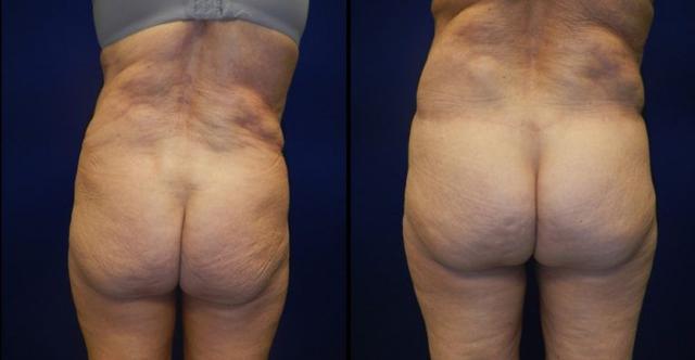 Brazilian Butt Lift result at Plastic Surgery Group of Memphis in Memphis, TN