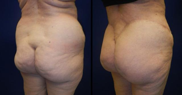 Brazilian Butt Lift result at Plastic Surgery Group of Memphis in Memphis, TN