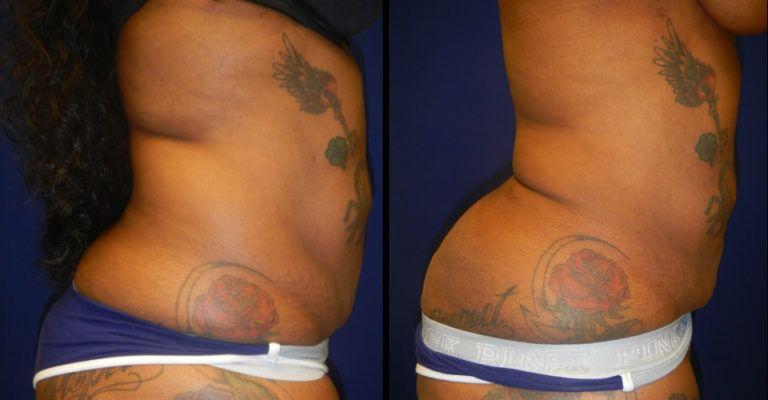 Plastic Surgery Group of Memphis liposuction result — Memphis, TN