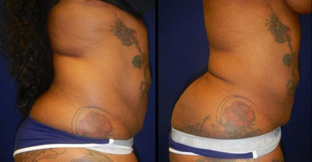 Liposuction result at Plastic Surgery Group of Memphis in Memphis, TN