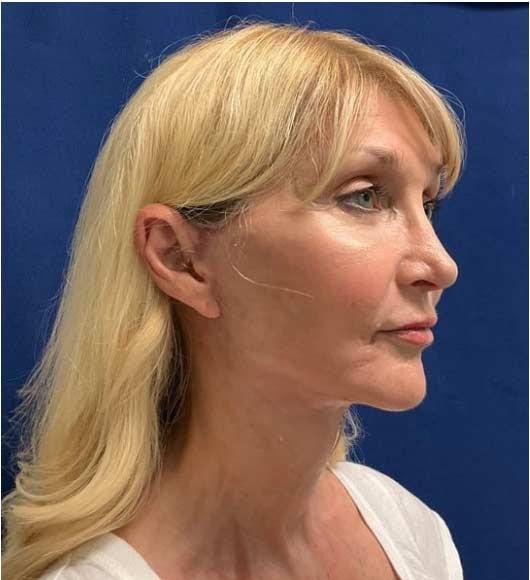 Gregory S. Keller, MD facelift after — Los Angeles, CA