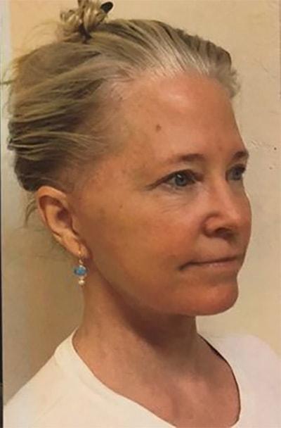 Gregory S. Keller, MD neck lift after — Los Angeles, CA
