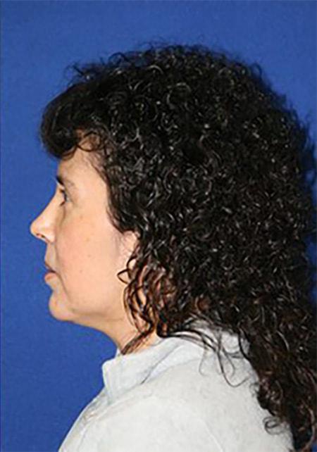 Gregory S. Keller, MD rhinoplasty after — Los Angeles, CA