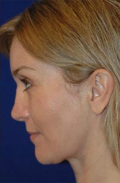 Gregory S. Keller, MD neck lift after — Los Angeles, CA