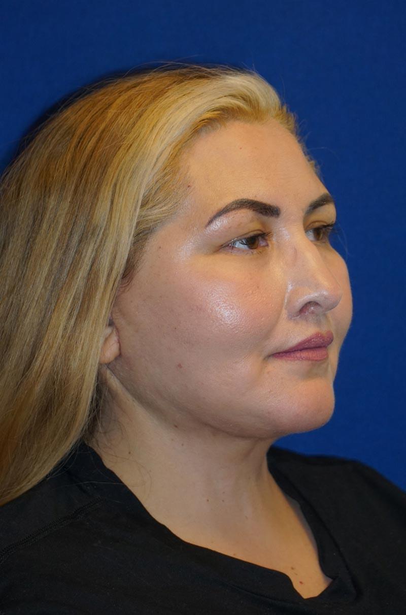 Gregory S. Keller, MD facelift after — Los Angeles, CA
