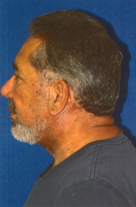 Facelift after at Gregory S. Keller, MD in Los Angeles, CA
