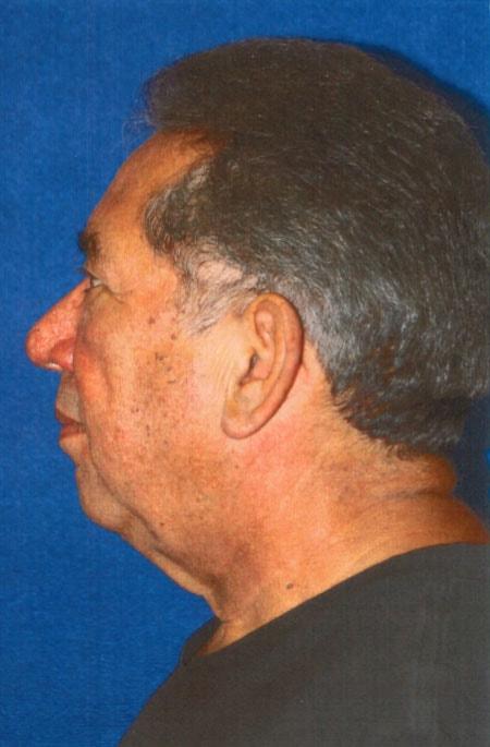 Facelift before at Gregory S. Keller, MD in Los Angeles, CA