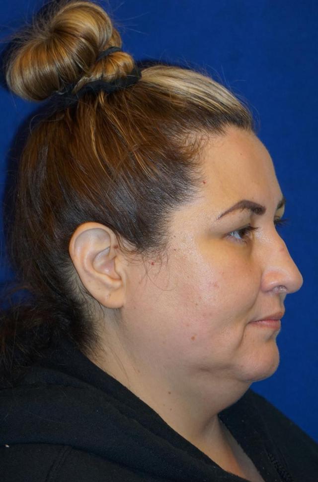 Facelift before at Gregory S. Keller, MD in Los Angeles, CA