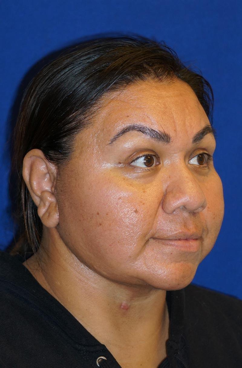 Gregory S. Keller, MD facelift after — Los Angeles, CA