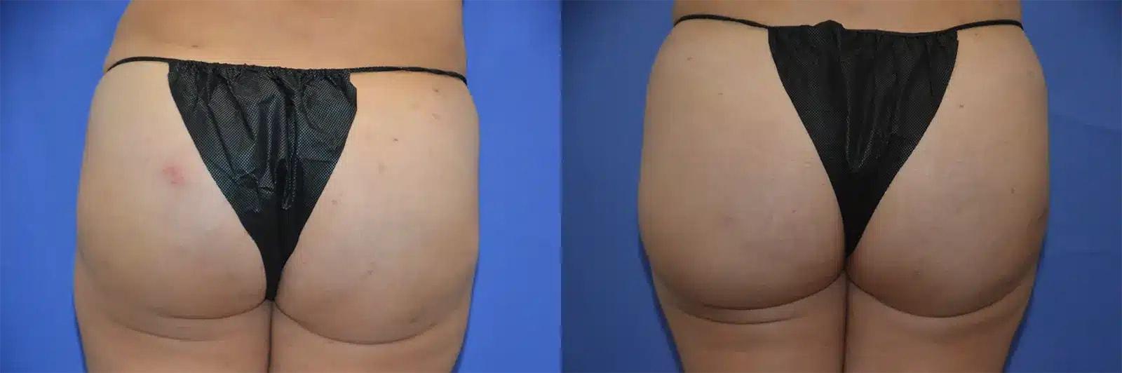 GLOW Surgical Arts bbl result โ Fremont, CA