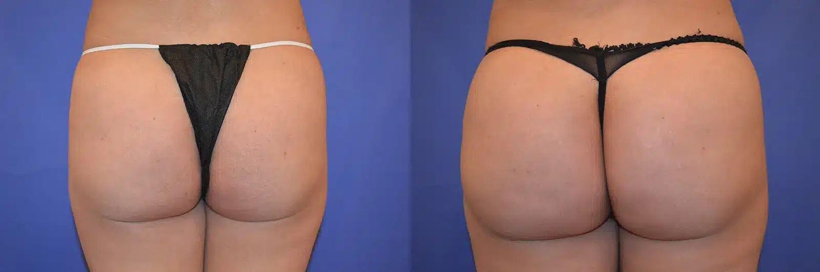 GLOW Surgical Arts bbl result โ Fremont, CA