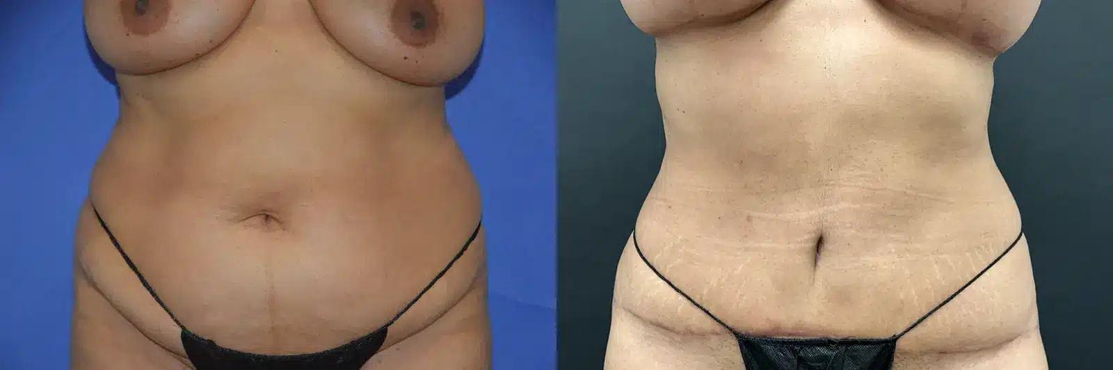 GLOW Surgical Arts tummy tuck result — Fremont, CA
