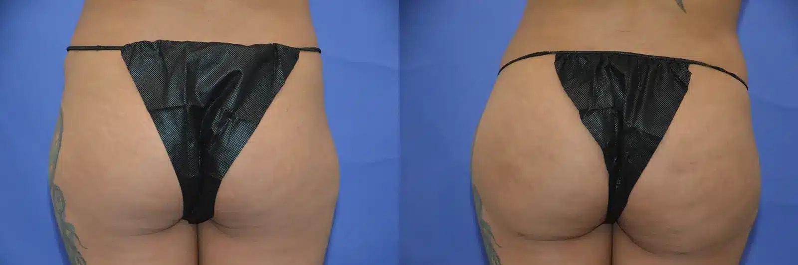 GLOW Surgical Arts bbl result — Fremont, CA