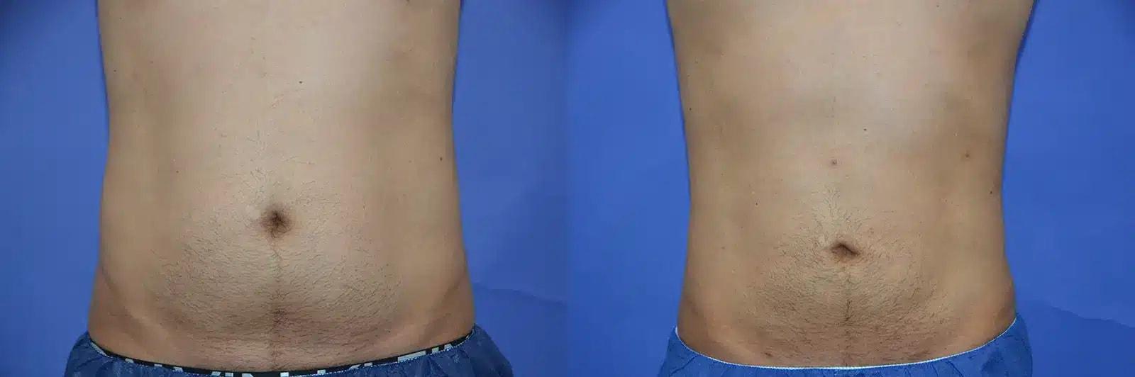 GLOW Surgical Arts liposuction result — Fremont, CA