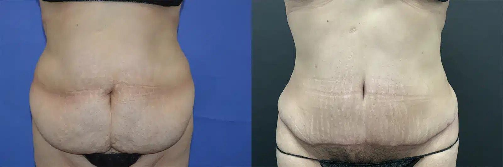 GLOW Surgical Arts tummy tuck result — Fremont, CA