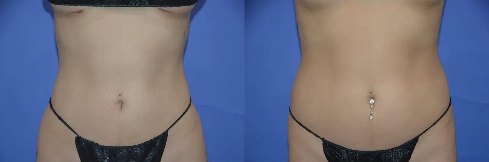 GLOW Surgical Arts liposuction result — Fremont, CA
