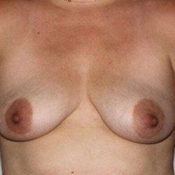 Breast Lift before at My Houston Surgeons in Houston, TX