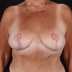 Breast Reduction after at My Houston Surgeons in Houston, TX