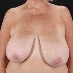 Breast Reduction before at My Houston Surgeons in Houston, TX